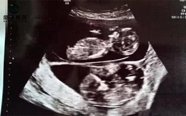 廣東男子做親子鑒定，竟發(fā)現(xiàn)自家雙胞胎有一個不是自己的？！