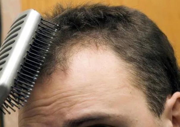 毛發(fā)可以做親子鑒定檢材嗎，怎么采集樣本才可以？